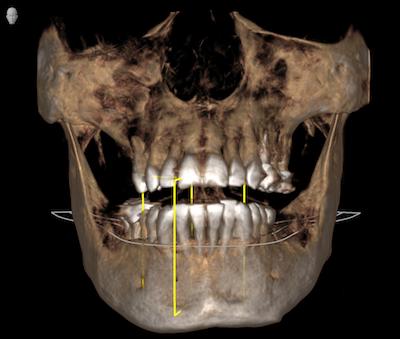 CBCT Scan